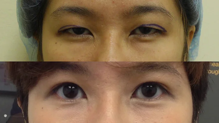 #ChaseLayMD Double Eyelid Surgery Cantonese Patient Healing Process - DayDayNews