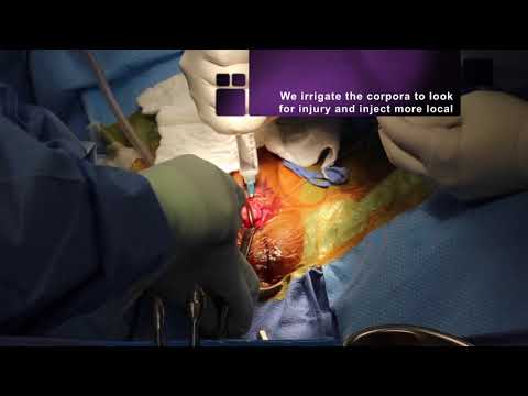 勃起不全のためのsurbexz