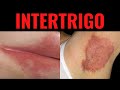 What Is Intertrigo Intertrigo Definition Causes Symptoms Treatment Risk Factors USMLE What Is Intertrigo Intertrigo Definition Causes Symptoms Treatment Risk Factors USMLE