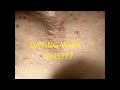 Having a relationship/dating with severe acne (My experiences)
