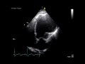 LEFT VENTRICULAR  ANEURYSM / ECHOCARDIOGRAPHY