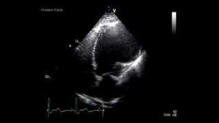 LEFT VENTRICULAR  ANEURYSM / ECHOCARDIOGRAPHY