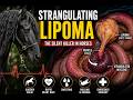 What is a Strangulating Lipoma in Horses? Symptoms, Survival & Emergency Treatment