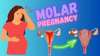 Molar pregnancy | Hydatiform Mole, Risk Factors, Types, Symptoms, Diagnosis, And Treatment (GTD)