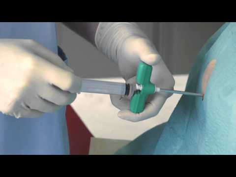 Lehrfilm Knochenmarkpunktion (bone marrow biopsy instructional) - YouTube