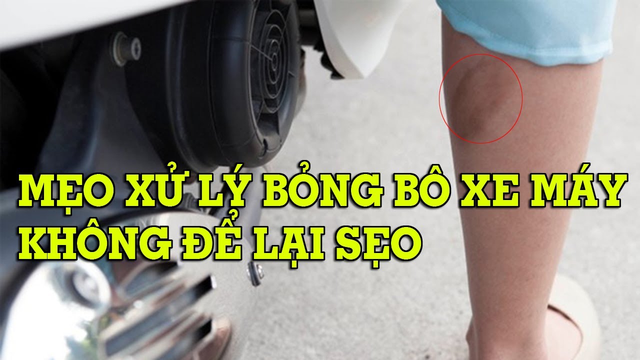 Cách xử lý khi bị bỏng bô xe máy không để lại sẹo - Mẹo Vặt Cuộc Sống