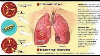 Вдохнуть и не дышать. Туберкулез в Екатеринбурге