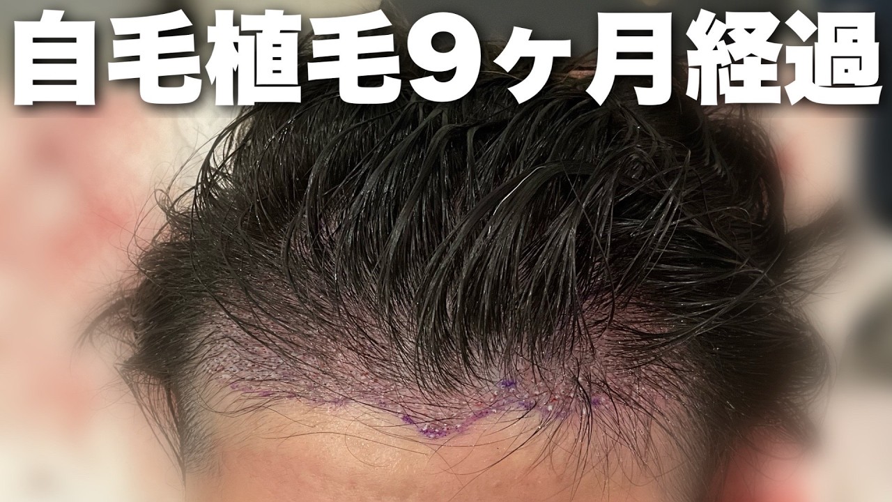 毛髪 - ガイドライン2017を踏まえた治療update Amazon.co.jp: 毛髪