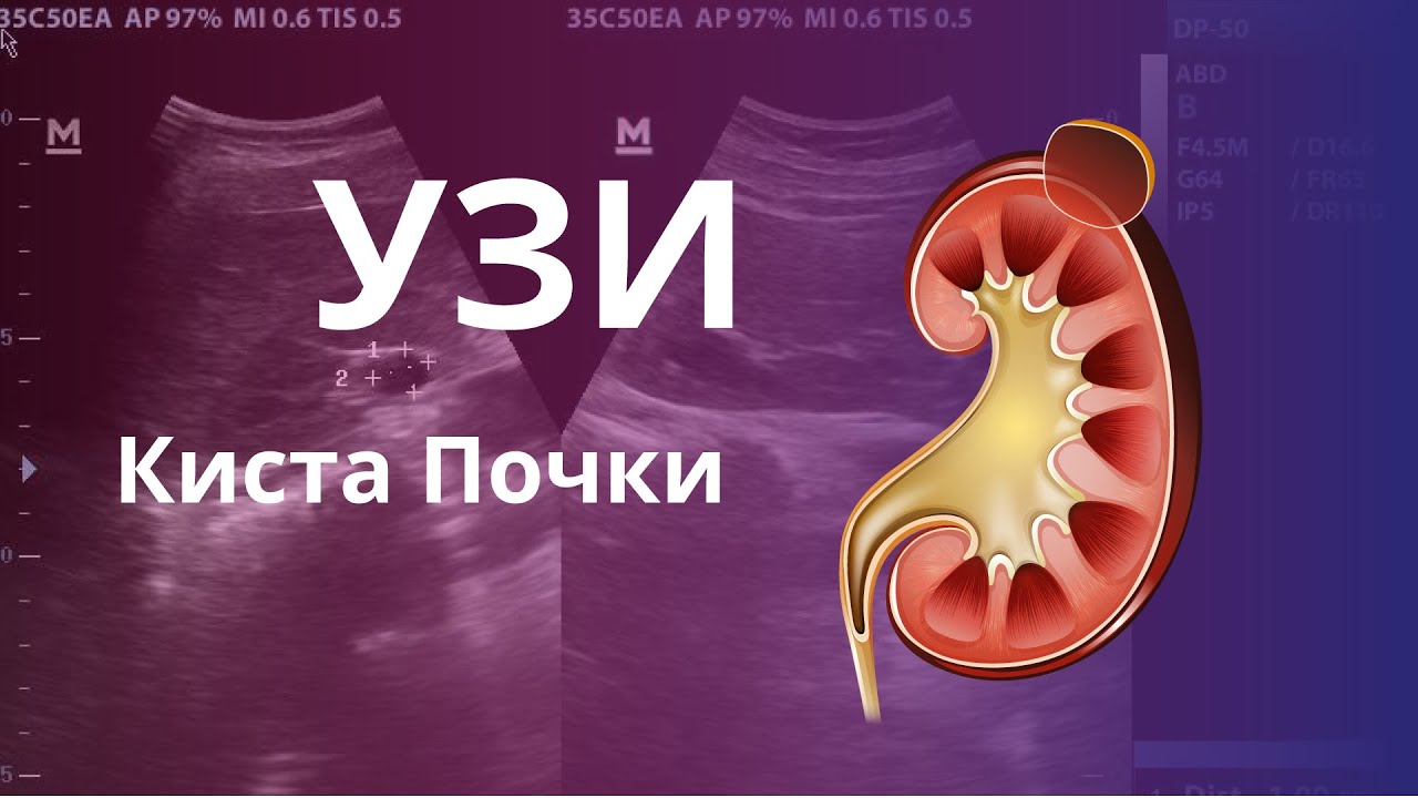 Киста почки. УЗИ характеристика простой и коплексной кисты. Классификация кист по Босняк.