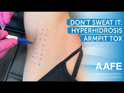 Don't Sweat It: Hyperhidrosis Armpit Tox