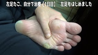 左足たこ、自分で治療【1日目】　左足もはじめました　help me