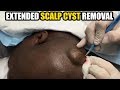 MASSIVE Scalp Cyst Removal, Extended Extraction | John Gilmore M.D.