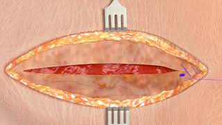 Stratafix Symmetric Pds Plus In Fascia