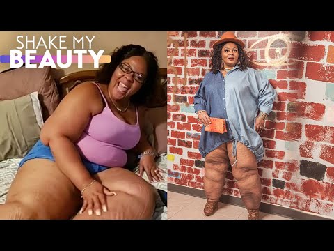 I've Hidden My Lipedema Legs - Until Today | SHAKE MY BEAUTY