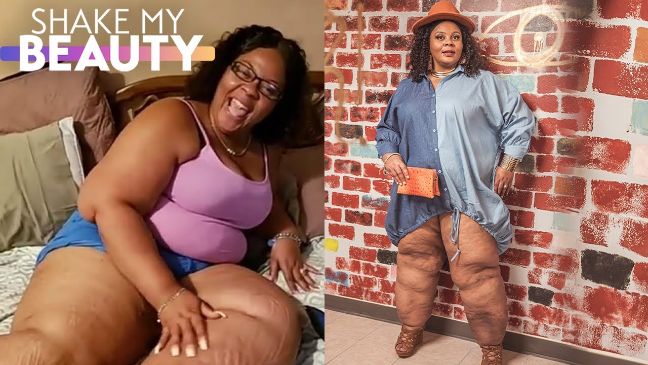 I've Hidden My Lipedema Legs - Until Today | SHAKE MY BEAUTY