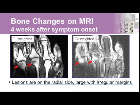 Video: Gør Dette, Ikke Det: En Guide Til At Leve Med Reumatoid Arthritis