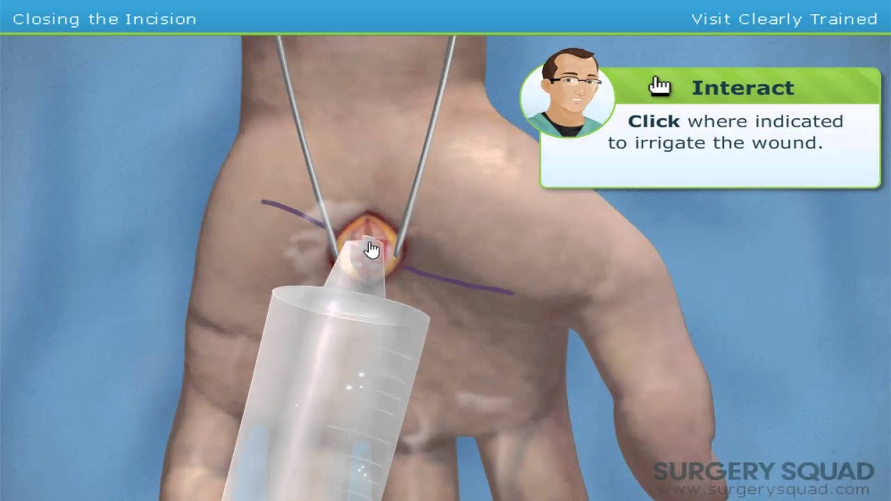 El Tunel Carpiano :$ | Surgery Squad