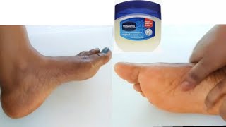 Remove wrinkles from foot in 5 minutes | Make your foot look 20 years younger - Get baby soft foot screenshot 3