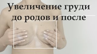 Увеличение груди до родов или после? (вопросы-ответы) Увеличение груди до родов или после? (вопросы-ответы)