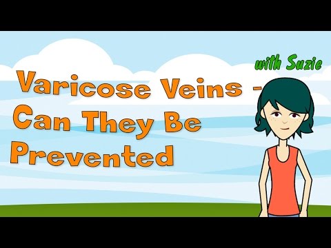 varicose-veins---can-they-be-prevented?