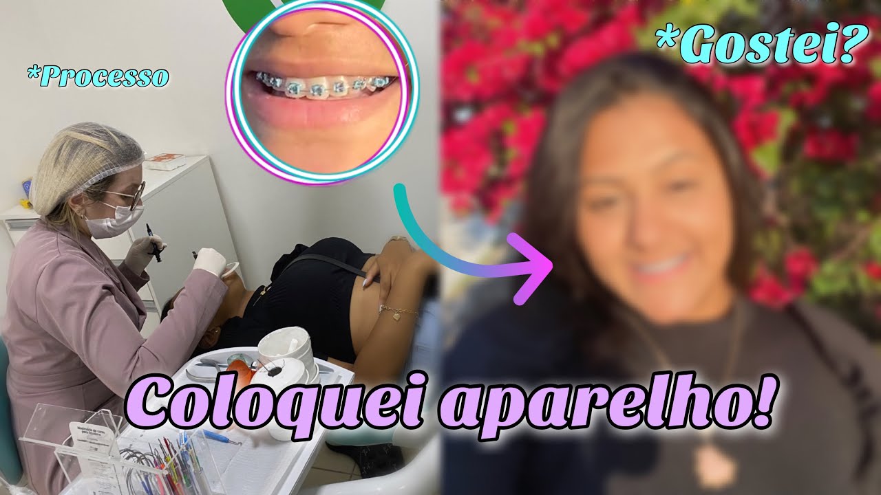 Vlog - Coloquei aparelho + Minha reação | Doeu? 😬