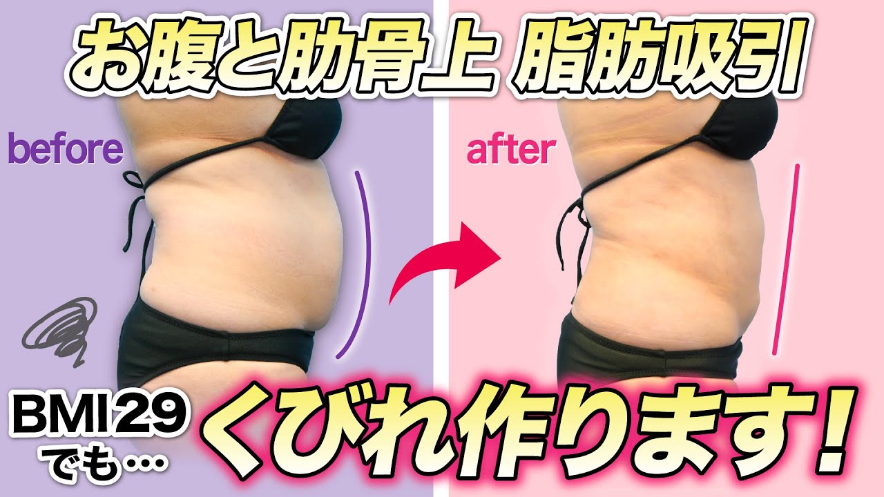 37歳・BMI29】お腹ぐるっと一周脂肪吸引した結果 - YouTube