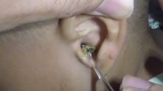 Click the link to get our earwax removal tool https://amzn.to/2zylrwr
this is how remove a giant dry ear wax in 2 yr. old boy please give
thumbs up to...