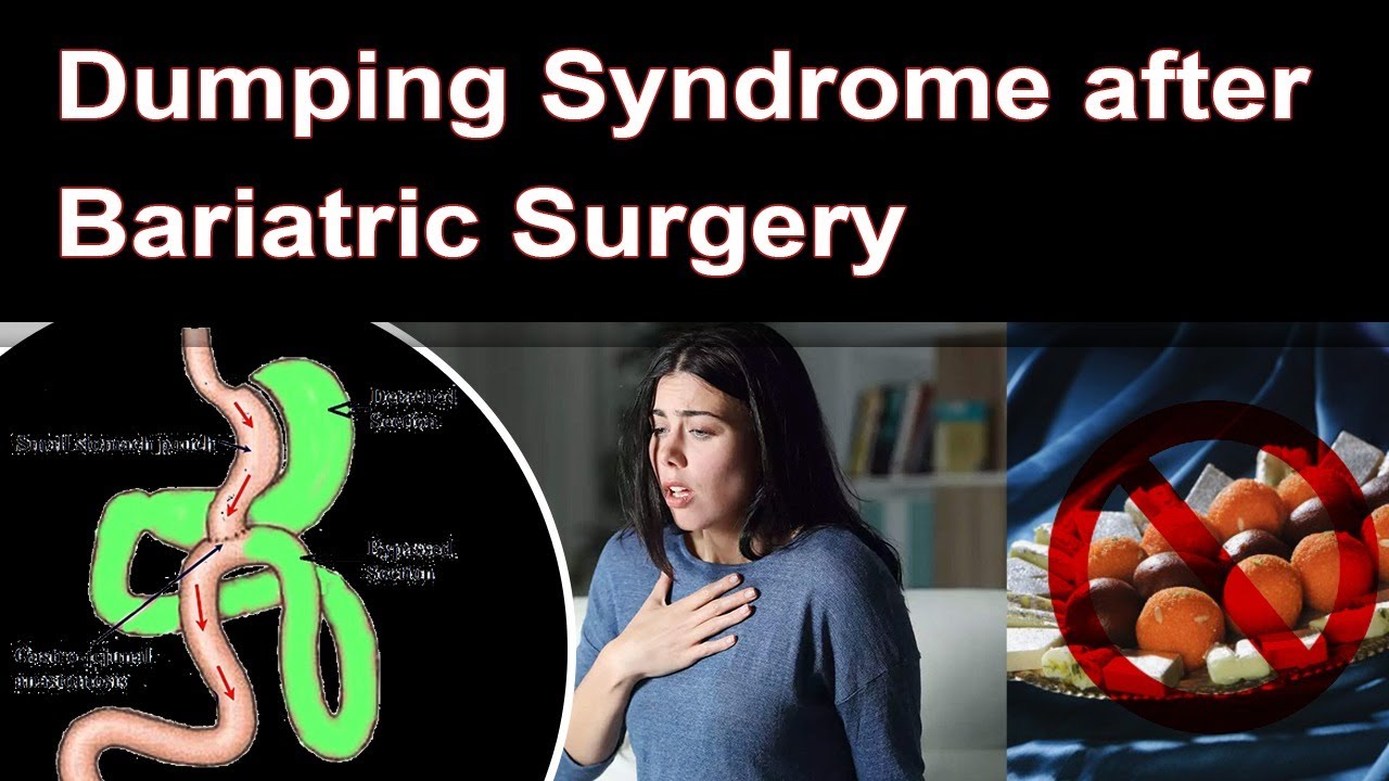 What is Dumping Syndrome? How Mini Gastric Bypass Surgery helps to