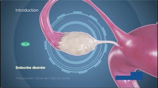 Polycystic ovary syndrome (PCOS) pathophysiology, causes, diagnosis , treatment #3D #animation