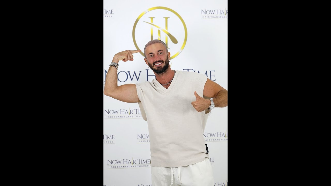 Luca Barbagallo sceglie Now Hair Time Clinic per il suo trapianto Fue