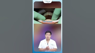 Niềng Răng Mặt Trong Có Gây Rát Lưỡi Không | Nha Khoa Minh Châu