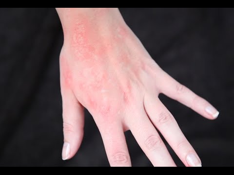 Rash - SFX makeup Tutorial