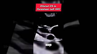 Dilated CS in Persistent LSVC #echo