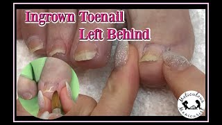 How to Pedicure Tips and Ingrown Toenail Removal Left Behind
