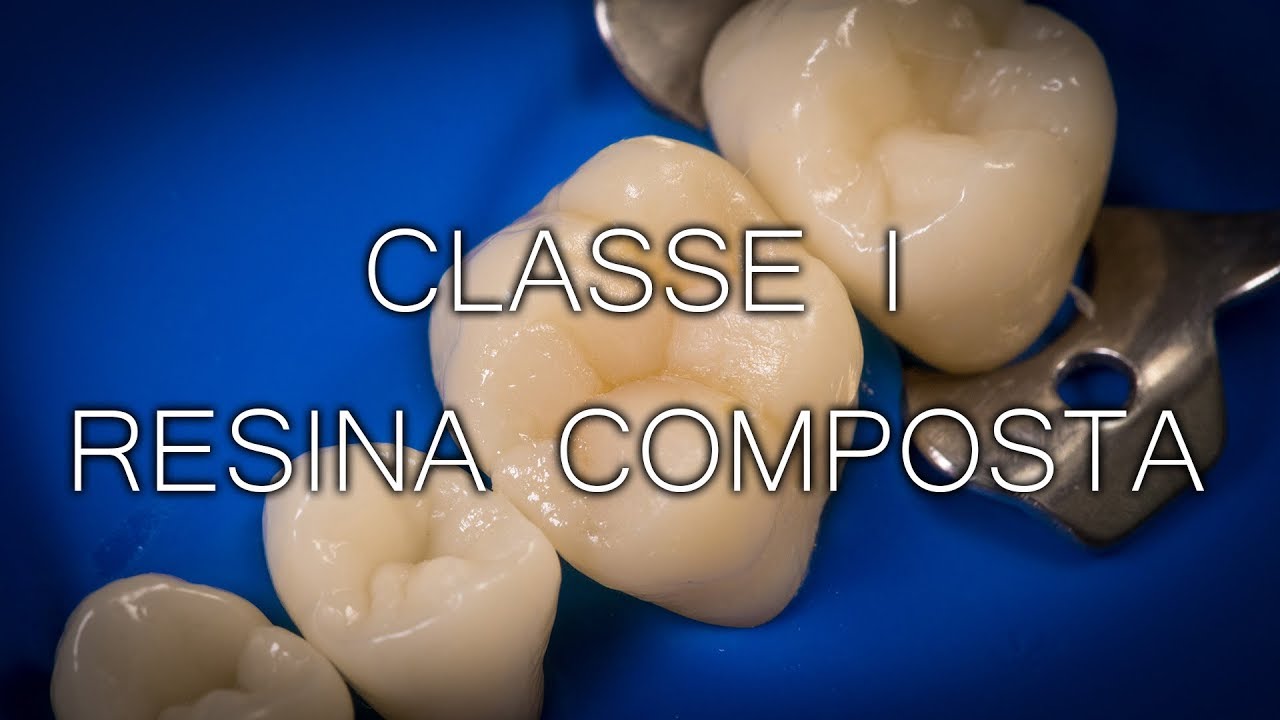 Restauração classe 1 em resina composta - Técnica de estratificação e adesão completa!