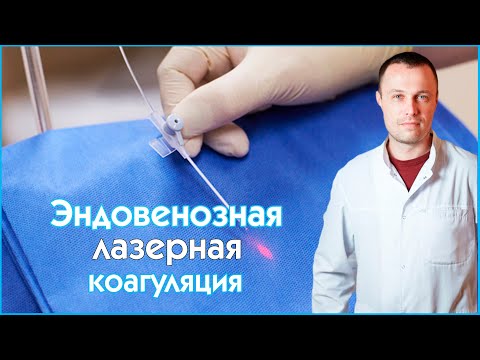 Эндовенозная лазерная коагуляция