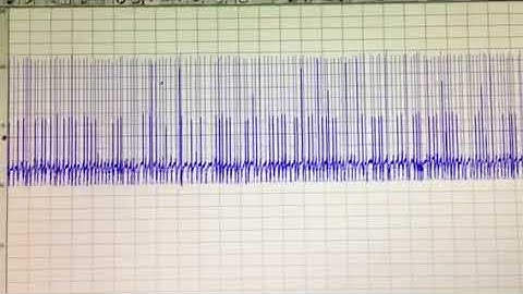 Action Potentials in neurons of the NTS