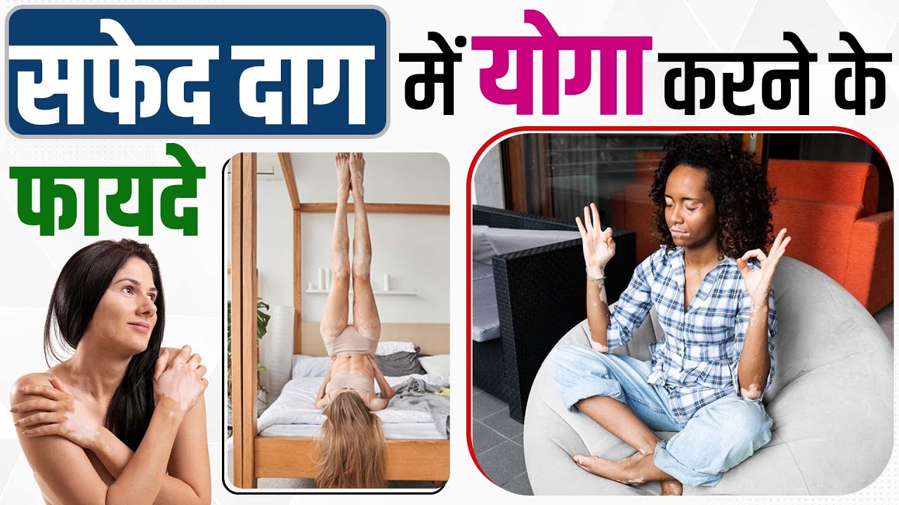 Safed daag me Yoga ke Fayade Benefits of Yoga for Vitiligo White