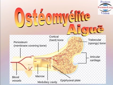 Vidéo: Ostéomyélite - Causes Et Symptômes De L'ostéomyélite Aiguë Et Chronique, Diagnostic Et Traitement