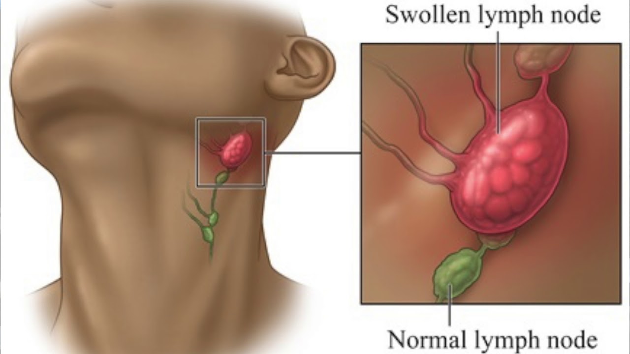 Как узнать лимфоузел. Тонзилярный лимфоузлы. Воспалённые лимфоузлы. Как выглядят воспаленные лимфа узлы.