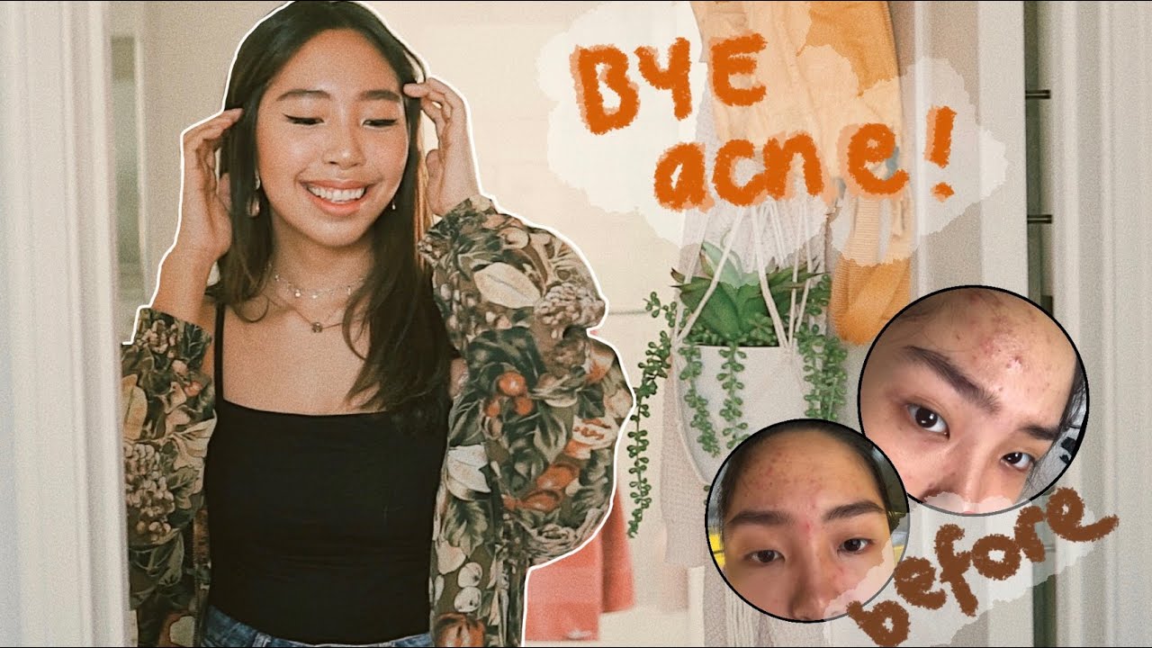 how i got rid of my acne - YouTube