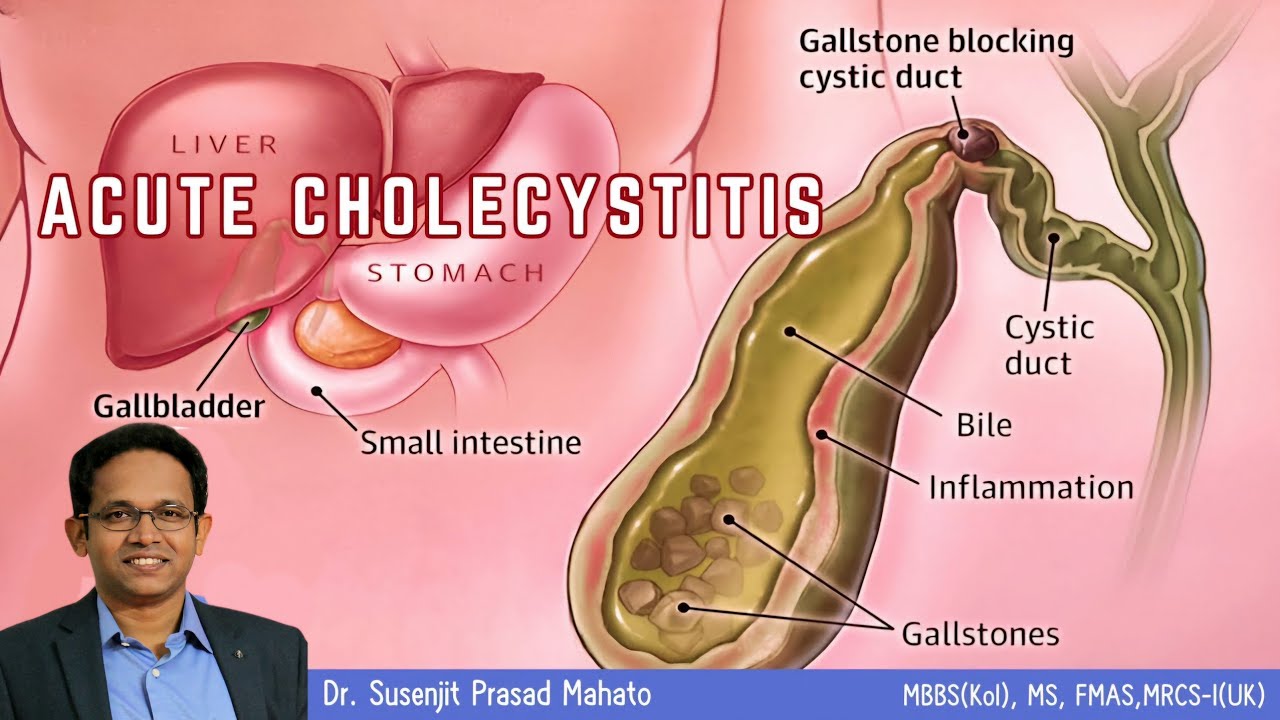 what-is-acute-cholecystitis-youtube