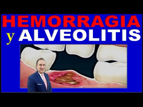 ALVEOLITIS (OSTEITIS ALVEOLAR O ALVEOLO SECO) Y HEMORRAGIA CAUSAS