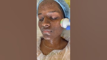 Hydrafacial treatment ❤️✨