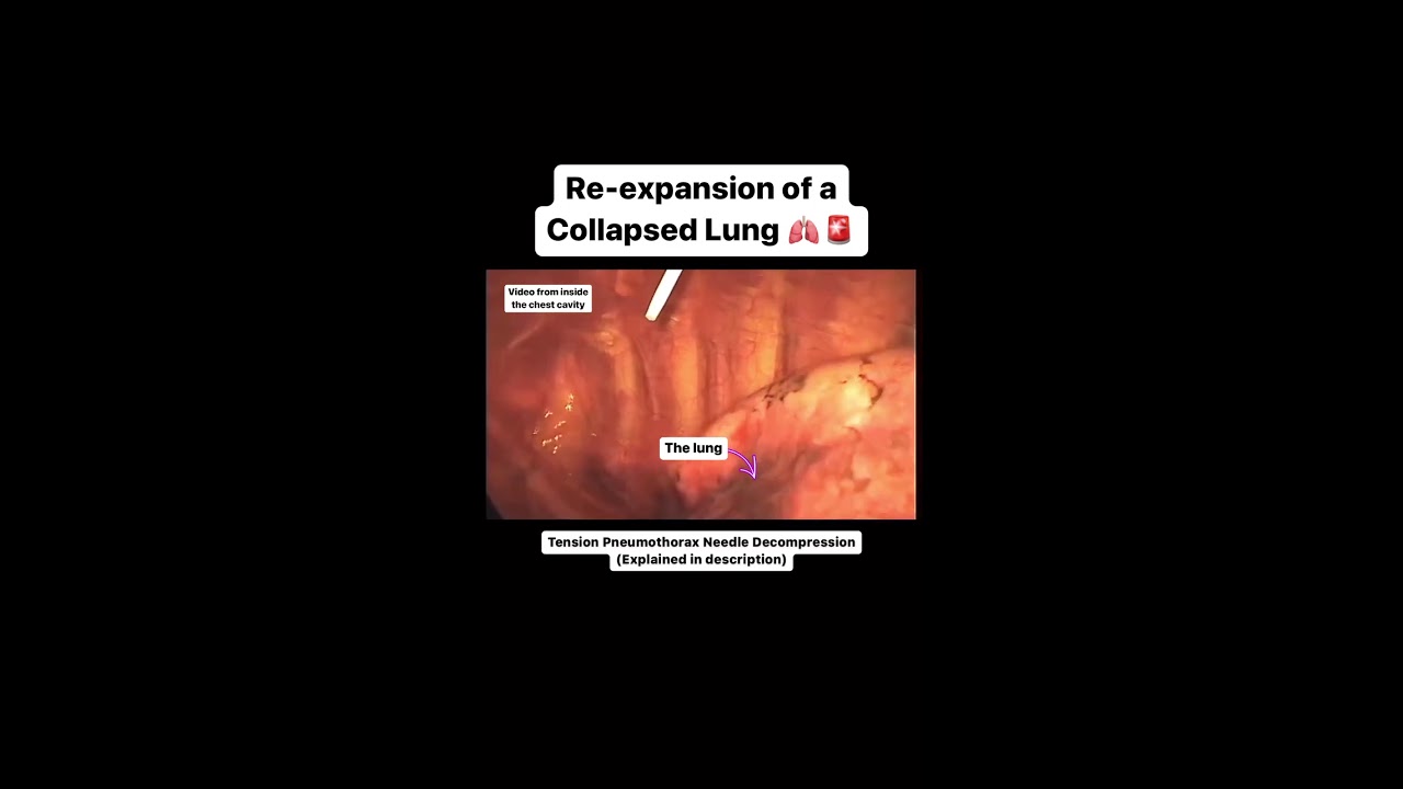 Collapsed Lung Re-expanding via Needle Decompression
