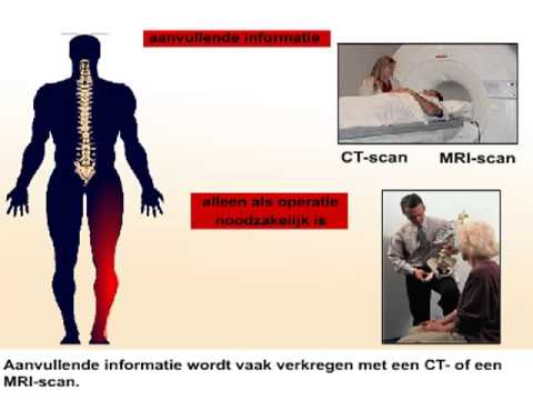 Video: Uitgegleden (hernia) Schijf: Symptomen, Oorzaken En Effecten