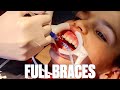 GETTING BRACES FOR THE FIRST TIME | TOP AND BOTTOM BRACES PUT ON WITH EXPANDER