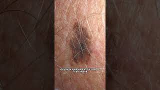 Melanoma of the scalp | Dr. Anna Chacon