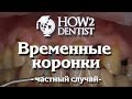Как сделать времянки при разрушенной коронке / How to Dentist