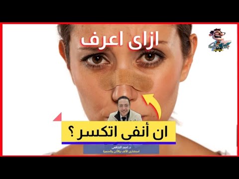 أعراض كسر الأنف وتشخيصه اهلا يا دكتور تخصص أمراض الأنف والأذن والحنجرة أحدث طرق علاج كسر الأنف